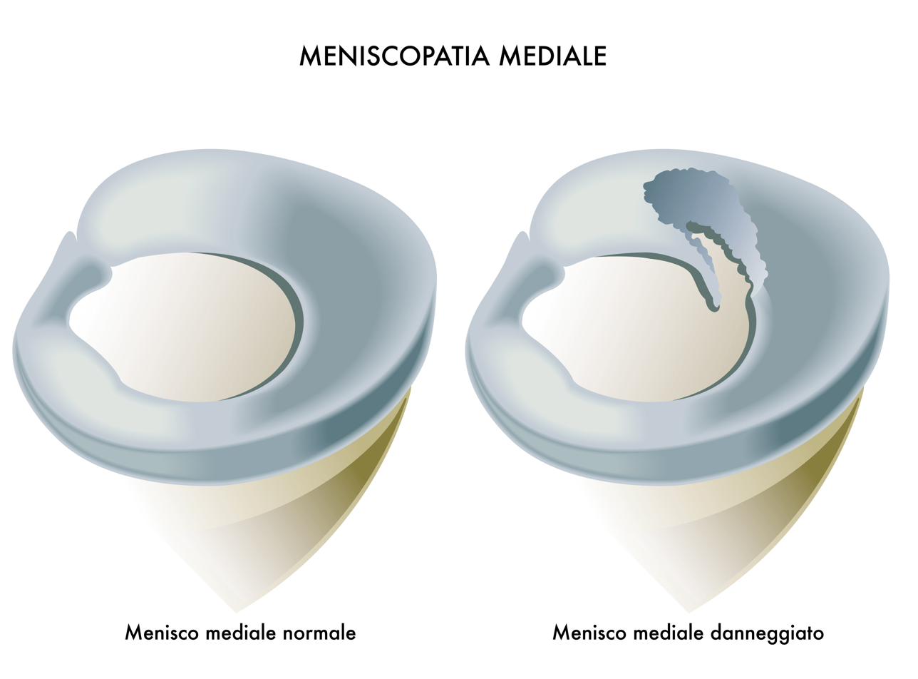 Rottura Menisco