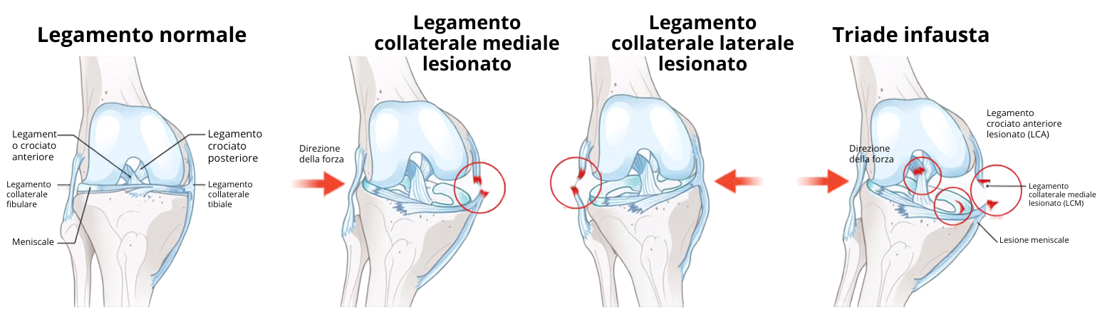 Pattern di lesione legamentosa del ginocchio: legamento normale, lesione del collaterale mediale, lesione del collaterale laterale, triade infausta