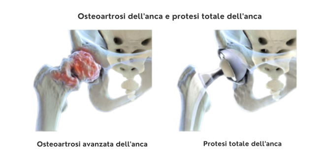 Osteoartrosi dell'anca e protesi totale dell'anca